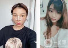 隆鼻第一天，迫不及待的想和大家分享