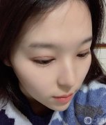 。手術(shù)前我是單眼皮純，沒有雙眼皮的痕跡，我一直夢想如果我有雙眼皮