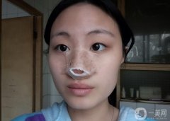 鼻子塌了，鼻子寬了，臉看起來扁扁的，不立體，一直想要個高鼻子