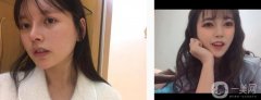 光子嫩膚后一個月，發(fā)現身邊有朋友一直在做光子嫩膚，女生對美妝項目毫無抵