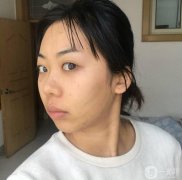 線雕完第七天了，現(xiàn)在臉上的針眼還看得見，但是結(jié)痂了