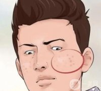 男士祛痘：戰(zhàn)斗痘疤，重拾自信
