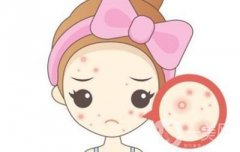 痘痘肌的福音!揭秘致痘成分，讓你遠離痘痘困擾