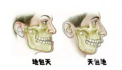 凸嘴正頜手術(shù)多少錢？手術(shù)時間、注意事項介紹詳細(xì)