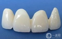 烏魯木齊烤瓷牙多少錢？烤瓷牙的適宜人群盤點