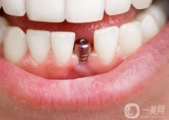 無錫種一顆牙價格多少錢？種植牙品牌怎么選？附五家靠譜醫(yī)院介紹