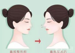 張軍醫(yī)生隆鼻案例分享，專家資料介紹、價格收費標準一覽