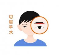 哪些人，哪些情況需要做切眉？