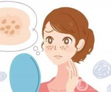 哪些斑適合激光調(diào)節(jié)