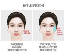 顴骨縮小手術(shù)方法有哪些