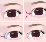開外眼角和開內(nèi)眼角哪個更好