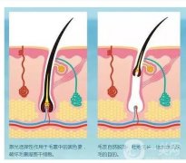 雞皮可以用激光去除嗎？