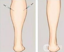 大腿環(huán)吸后腫脹怎么辦，要幾天才能恢復(fù)