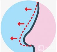 達(dá)拉斯的鼻整形效果可以持續(xù)很長(zhǎng)時(shí)間嗎