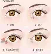 如何避免開(kāi)眼角的危險(xiǎn)？