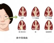 鼻中隔偏曲如何與矯正？