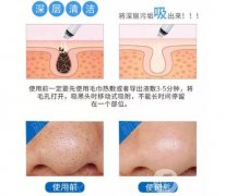 超微小氣泡可能產(chǎn)生哪些副作用？