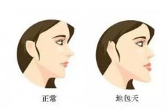 正頜手術(shù)有風險嗎？有哪些后遺癥