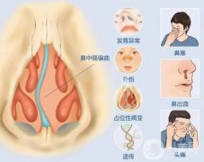 鼻中隔偏曲有哪些影響和危害
