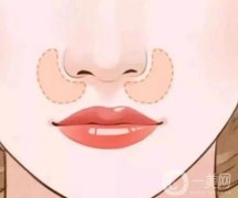 鼻基底填充的方法有哪些，可以鼻唇溝嗎
