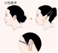 電波拉皮后要注意些什么？