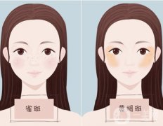 光子嫩膚可以徹底去除黃褐斑嗎？