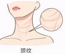 頸部除皺的方法有哪些？