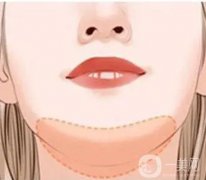 哪些人適合自體軟骨墊下巴，特點(diǎn)是什么