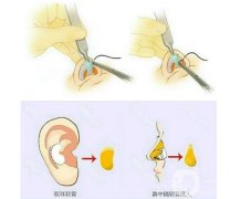 耳軟骨墊鼻尖可以捏嗎？多長(zhǎng)時(shí)間才能恢復(fù)
