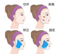 多維拉面部提升手術(shù)和埋線(xiàn)提升手術(shù)的區(qū)別