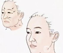 電波拉皮會(huì)對(duì)皮膚造成傷害嗎