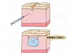 玻尿酸可以注射過量嗎？