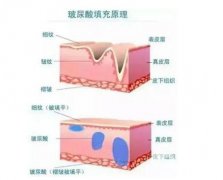 玻尿酸注射多少次效果可以永久