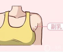 副乳切除術后應該怎么護理？