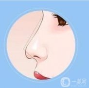 大蒜鼻整形需要多少錢