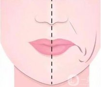 鼻基底有必要墊嗎？方法有幾種