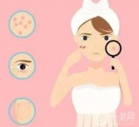 激光祛痘效果好嗎？要花多少錢