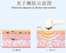 光子嫩膚可以徹底消除黃褐斑嗎？