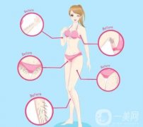 光子脫毛的價格影響因素是什么