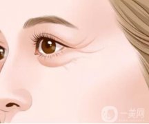 激光去除魚尾紋怎么樣，有副作用嗎