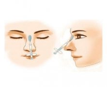 玻尿酸注射隆鼻有哪些風(fēng)險(xiǎn)，會(huì)透光嗎