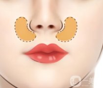 鼻基底填充常見的副作用有哪些