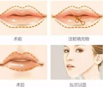 玻尿酸豐唇效果如何？有哪些優(yōu)勢