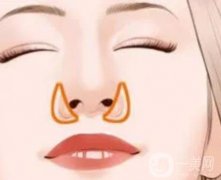 鼻翼外切術(shù)后如何恢復(fù)，注意事項有哪些
