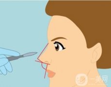 墊鼻梁手術(shù)前需要注意哪些事項？