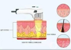 超聲波手術(shù)刀的效果如何？有副作用嗎