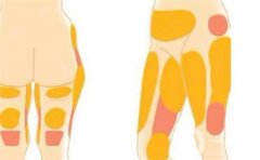 大腿哪些部位可以吸脂，效果如何
