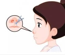 縮小鼻翼手術(shù)失敗怎么辦