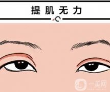 上瞼下垂手術(shù)有哪些后遺癥？