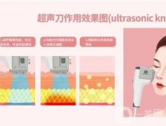 哪些人適合做超聲刀？對超聲刀會過敏嗎
